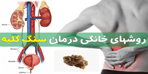 سنگ کلیه